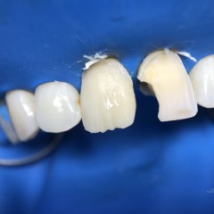 Процедура реставрации переднего зуба