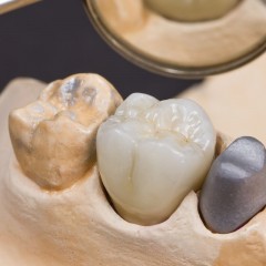 Фото коронки для жевательного зуба