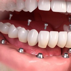 Изображение зубных имплантов на нижней челюсти