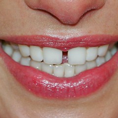 Фото щербинки между зубами
