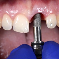 Имплант после удаления зуба