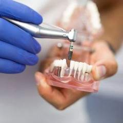 Фото зубной имплантат