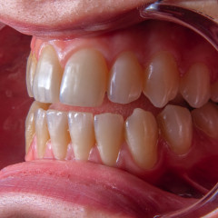Зубы и импланты