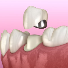 Изображение зубной коронки