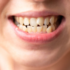 Фото скученных зубов