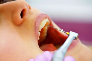 Особенности лечения корневых каналов зуба