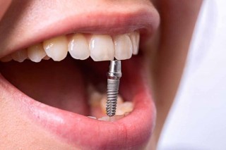 Привыкание к зубному импланту
