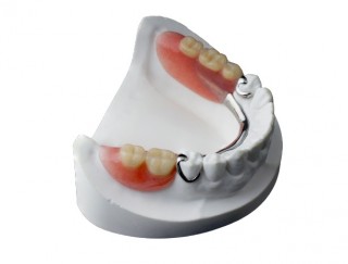 Съемный зубной протез для нижней челюсти 