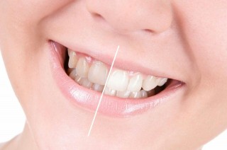 Изменение оттенка эмали зуба