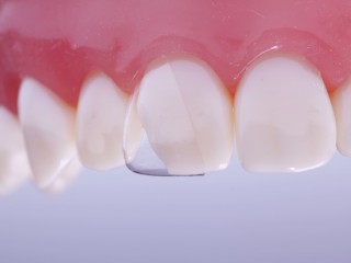 Тонкая зубная эмаль