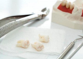 Удаление нескольких зубов
