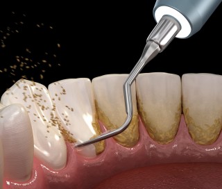 Откуда берутся камни на зубах и как избежать их появления?
