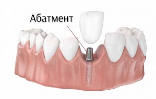 Абатмент импланта зуба