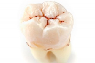 Фото зуба с фиссурным кариесом