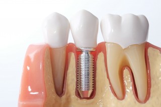 Изображение зубного импланта