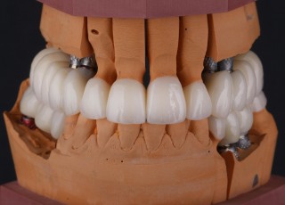 Фото челюсти с искусственными зубами