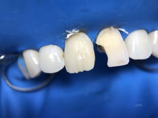 Процедура реставрации переднего зуба