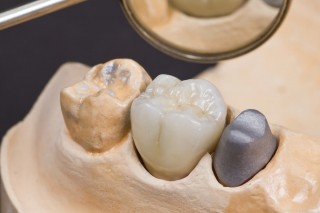 Фото коронки для жевательного зуба