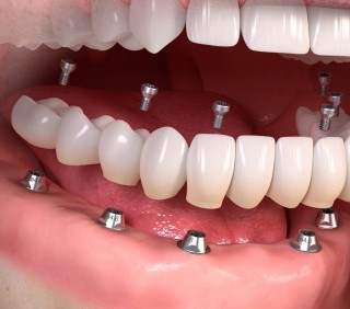 Изображение зубных имплантов на нижней челюсти