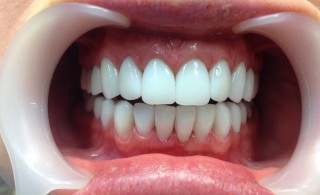 Изображению челюсти с протезом на нижних передних зубах