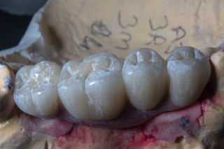 Фото зубной имплантат