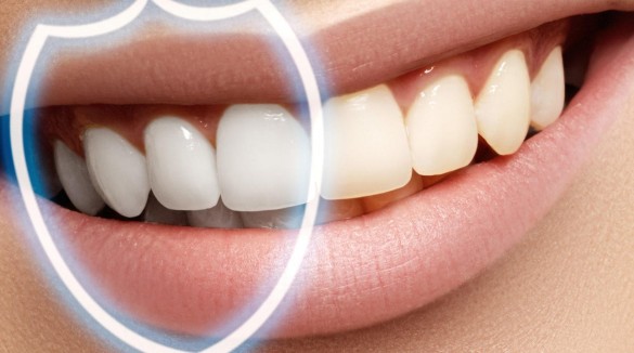 Фторирование - зубы под надежной защитой