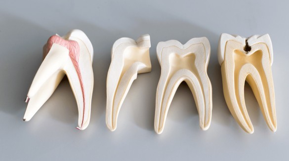 Пульпит зуба мудрости: симптомы и лечение