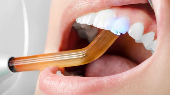 Фото процесс пломбирования зуба