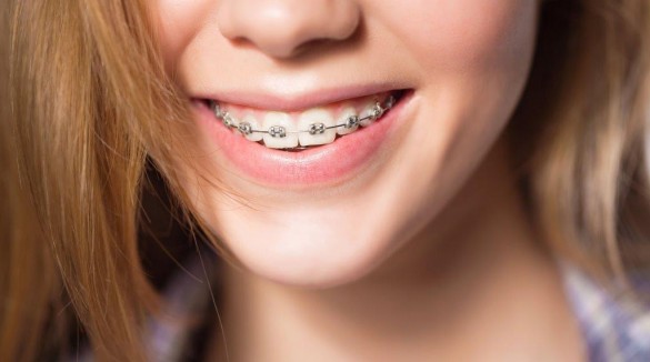 Фото девушка с брекетами на зубах