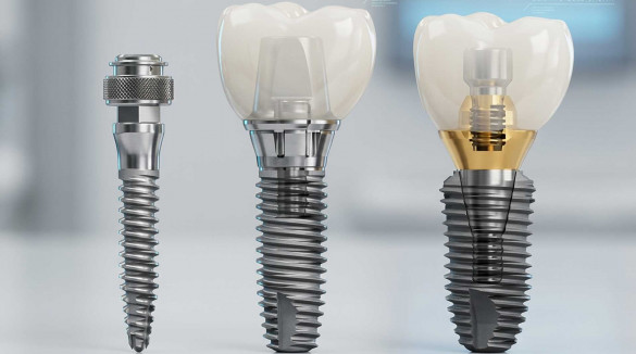 Импланты Dentium с абатментами и зубными коронками